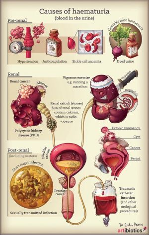 Blood In Urine (Hematuria): Causes, Diagnosis & Treatment