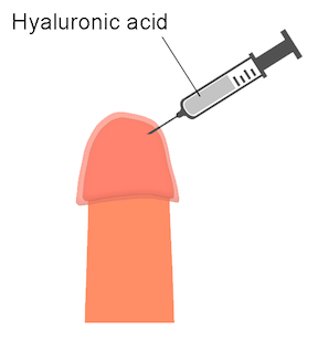 glans penis with Hyaluronic Acid for premature ejaculation